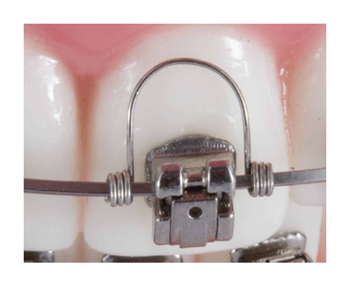 Reliance Warren Torquing Springs